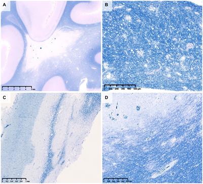 Pathology of myelin oligodendrocyte glycoprotein antibody-associated disease: a comparison with multiple sclerosis and aquaporin 4 antibody-positive neuromyelitis optica spectrum disorders